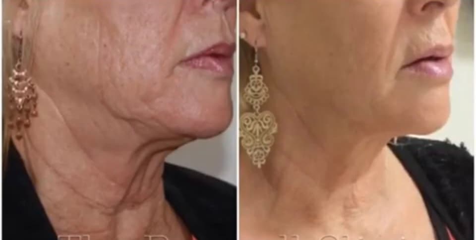 HiFu Treatment